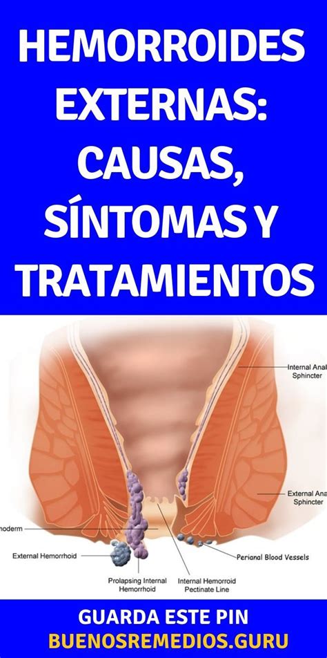 fotos reales de hemorroides|Fotos de hemorroides externas e internas (almorranas)